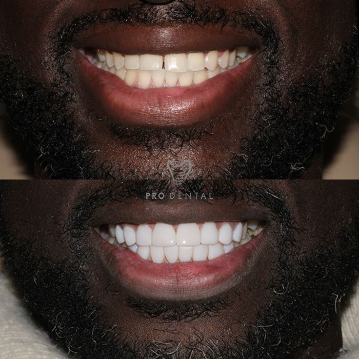 Dentifrice blanchissant